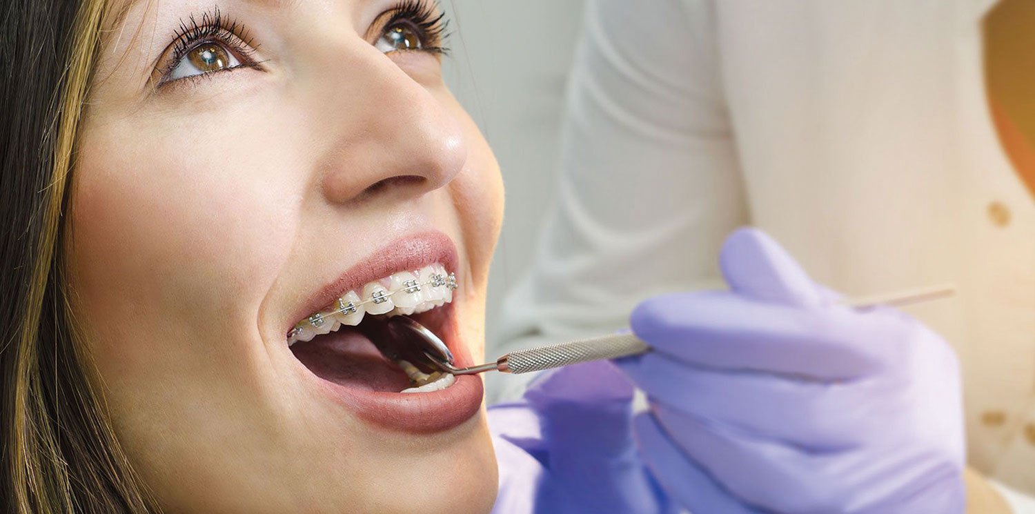 Life with Invisalign: What you need to know about caring for your aligners