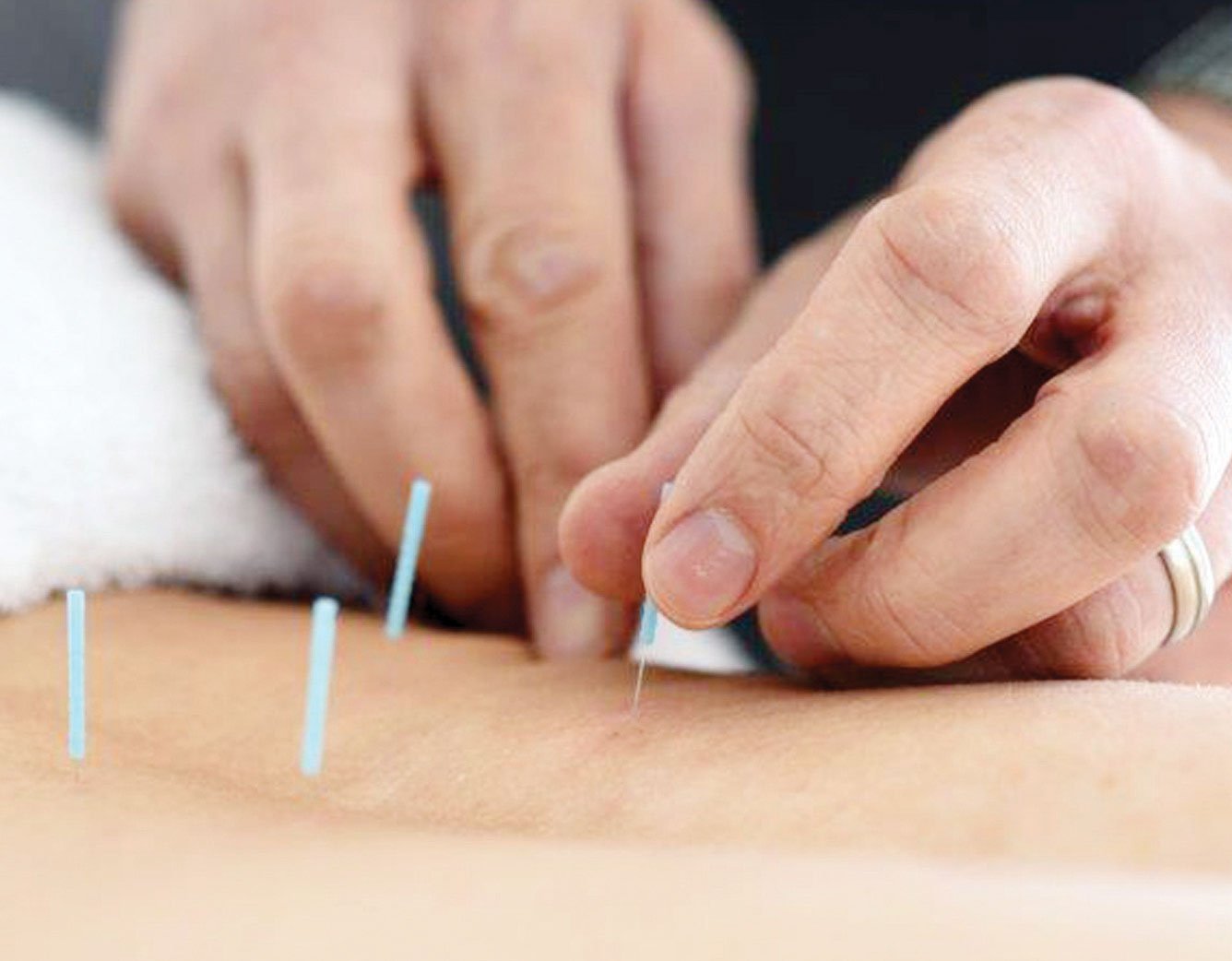The finest acupuncture therapy for your overall wellness