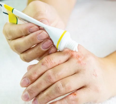All you need to know about eczema