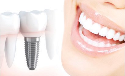 ALL ABOUT DENTAL IMPLANTS