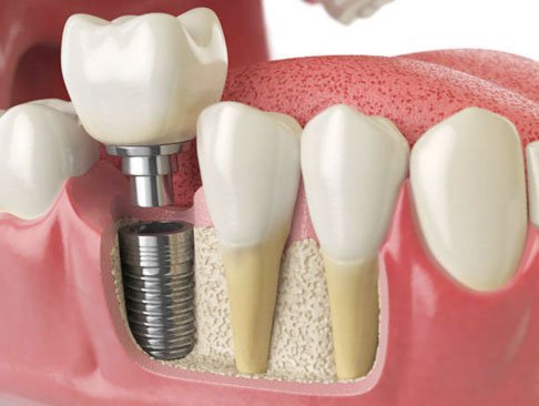 All About Dental Implants