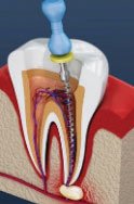 All about Root Canal treatment