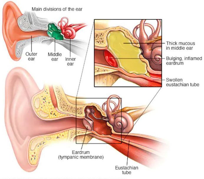 All you need to know about ear infection